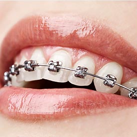 Airdrie Dental Braces | 8th Street Dental