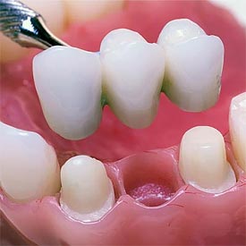 Airdrie Dental Bridges | 8th Street Dental