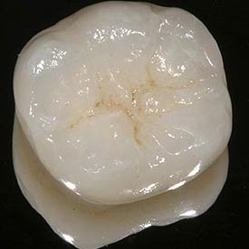 Dental Crowns