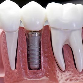 Airdrie Dental Implants | 8th Street Dental