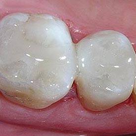 White Fillings