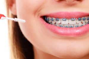 Dental braces pros and cons