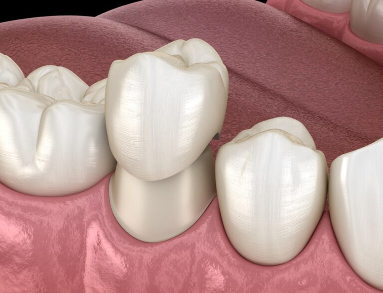 How long do dental crowns last? Airdrie 8th Street Dental