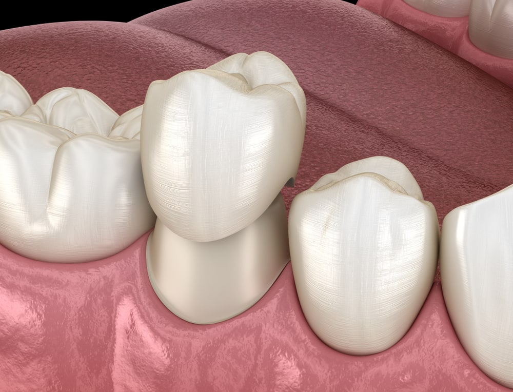 Dental crown be replacement Calgary