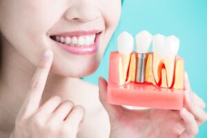 Dental Implant Services in Airdrie