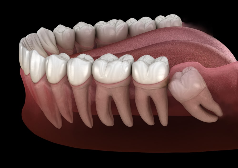 Wisdom Teeth Extraction Services in Airdrie