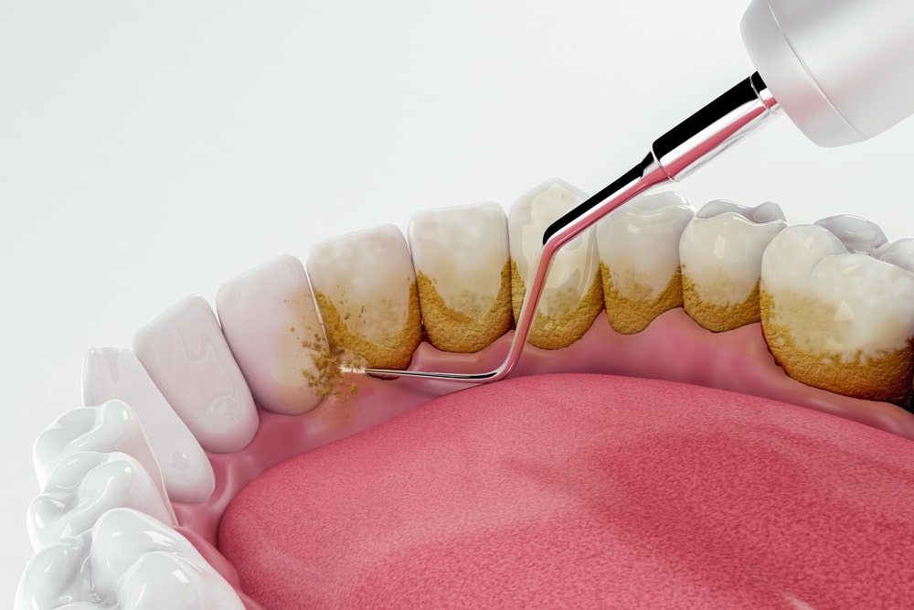 Cost of Dental Cleaning