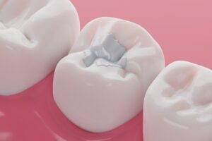 Dental White Fillings in Airdrie