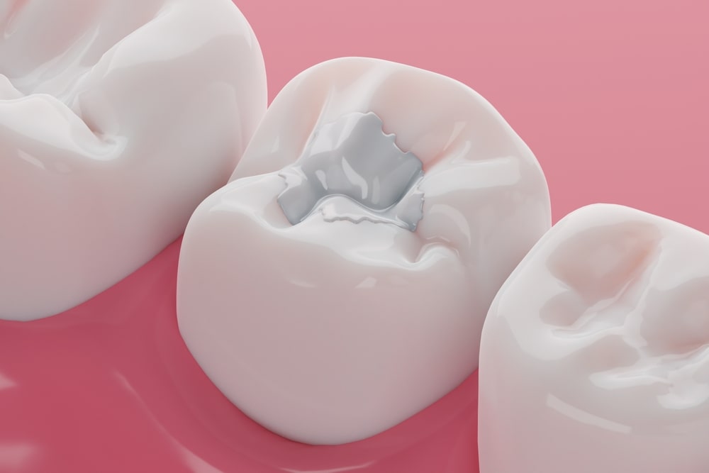 Dental White Fillings in Airdrie