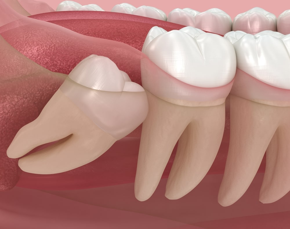 Wisdom Teeth Removal in Airdrie