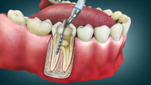 Root Canal Therapy in Airdrie